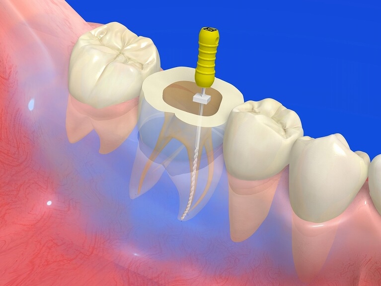 根管治療について